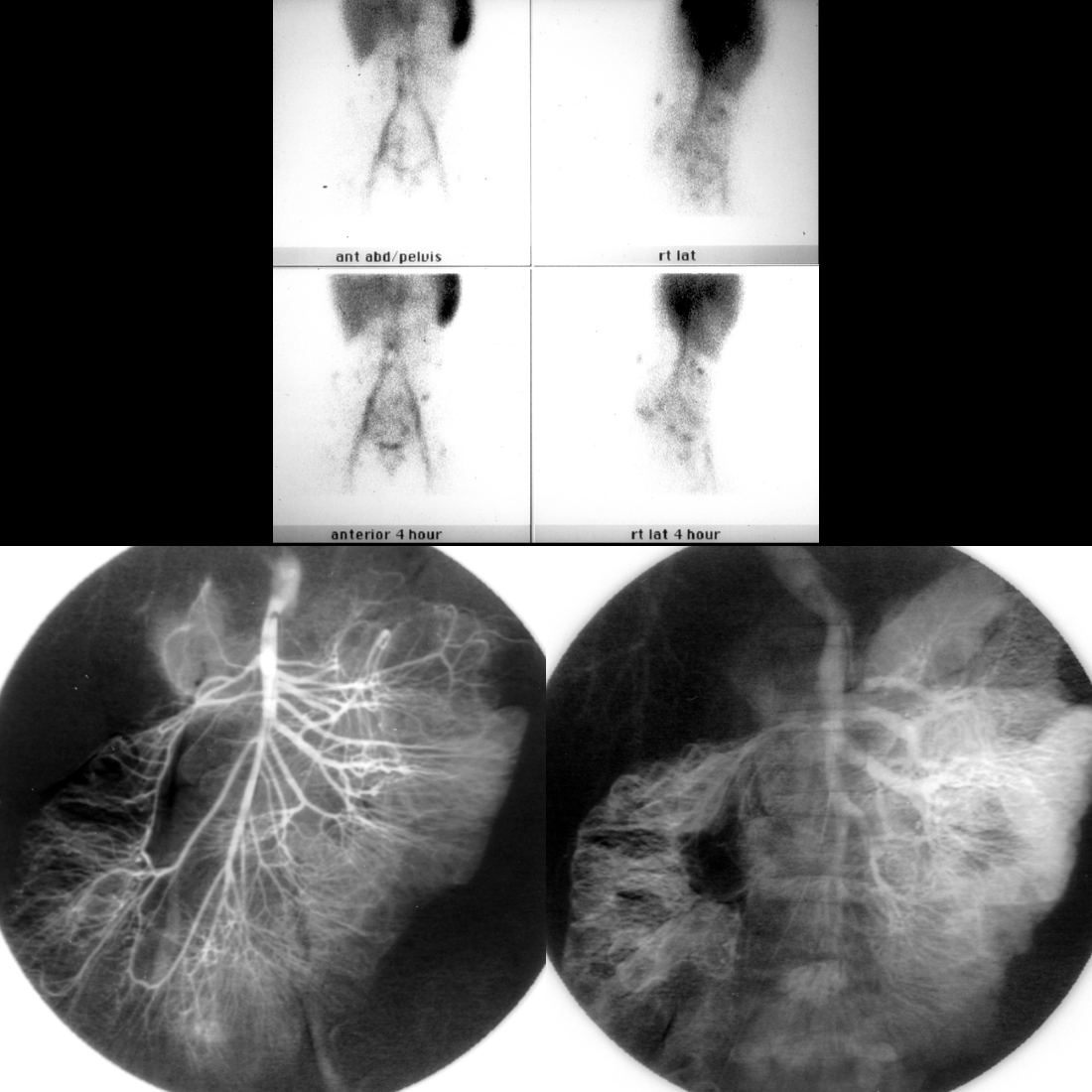 Tagged red blood cell nuclear medicine scan and angiogram of blue rubber bleb nevus syndrome