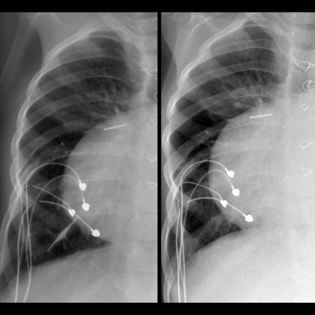 CXR of broken cardiac pacemaker leads