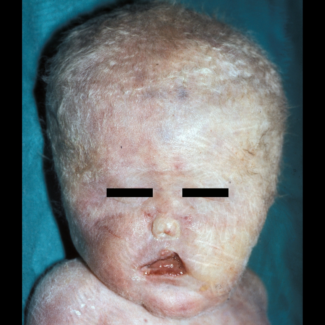 Newborn with abnormal facies