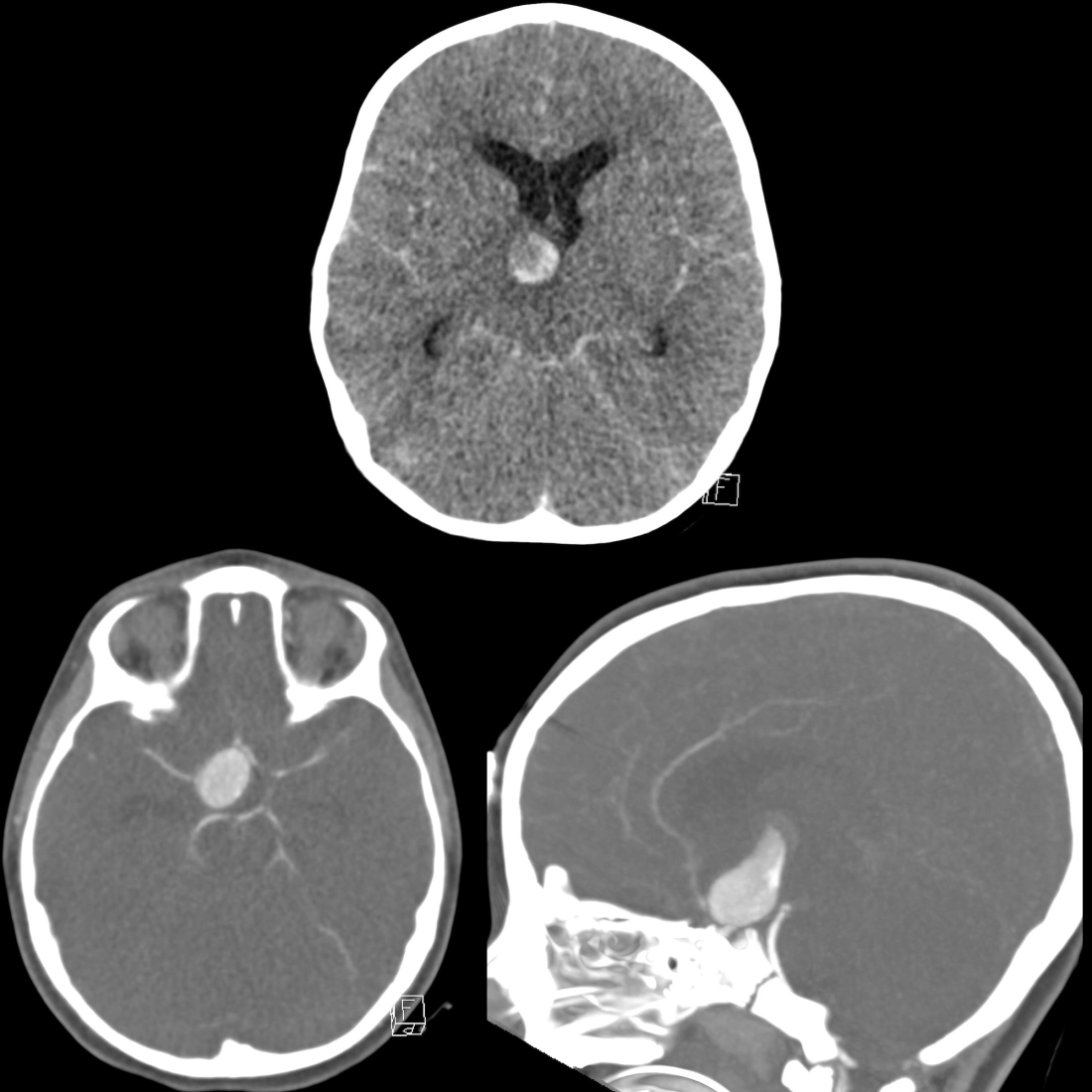 CT and CT angiogram of giant intracranial aneursym