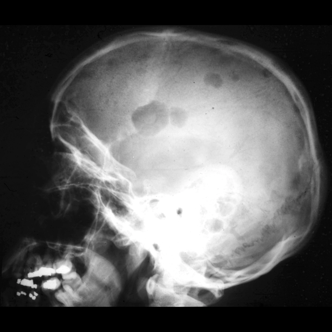 Radiograph of multiple myeloma of skull